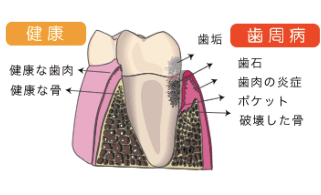 歯周病は実は防御反応だった