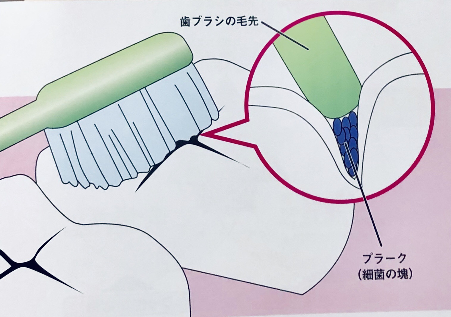歯周外科治療とは