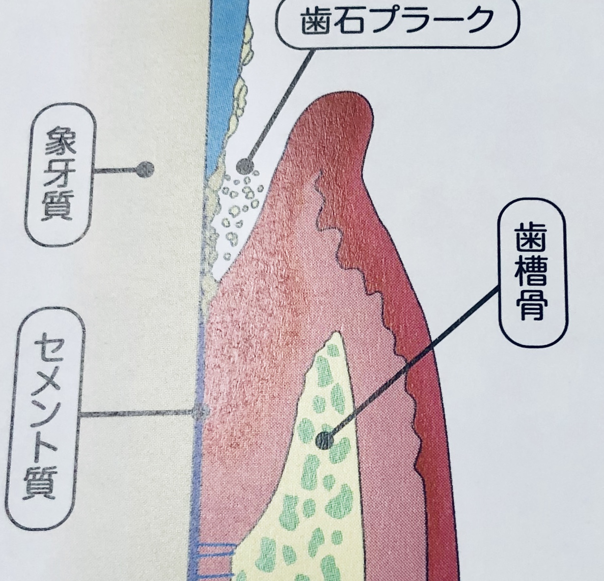 リグロスを用いる歯周組織再生療法
