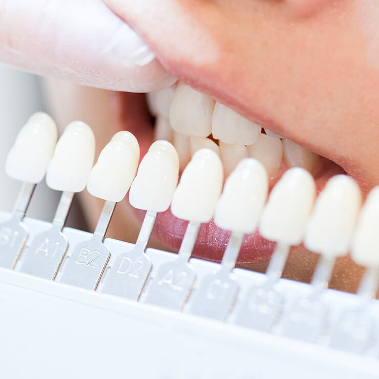 ホワイトニング